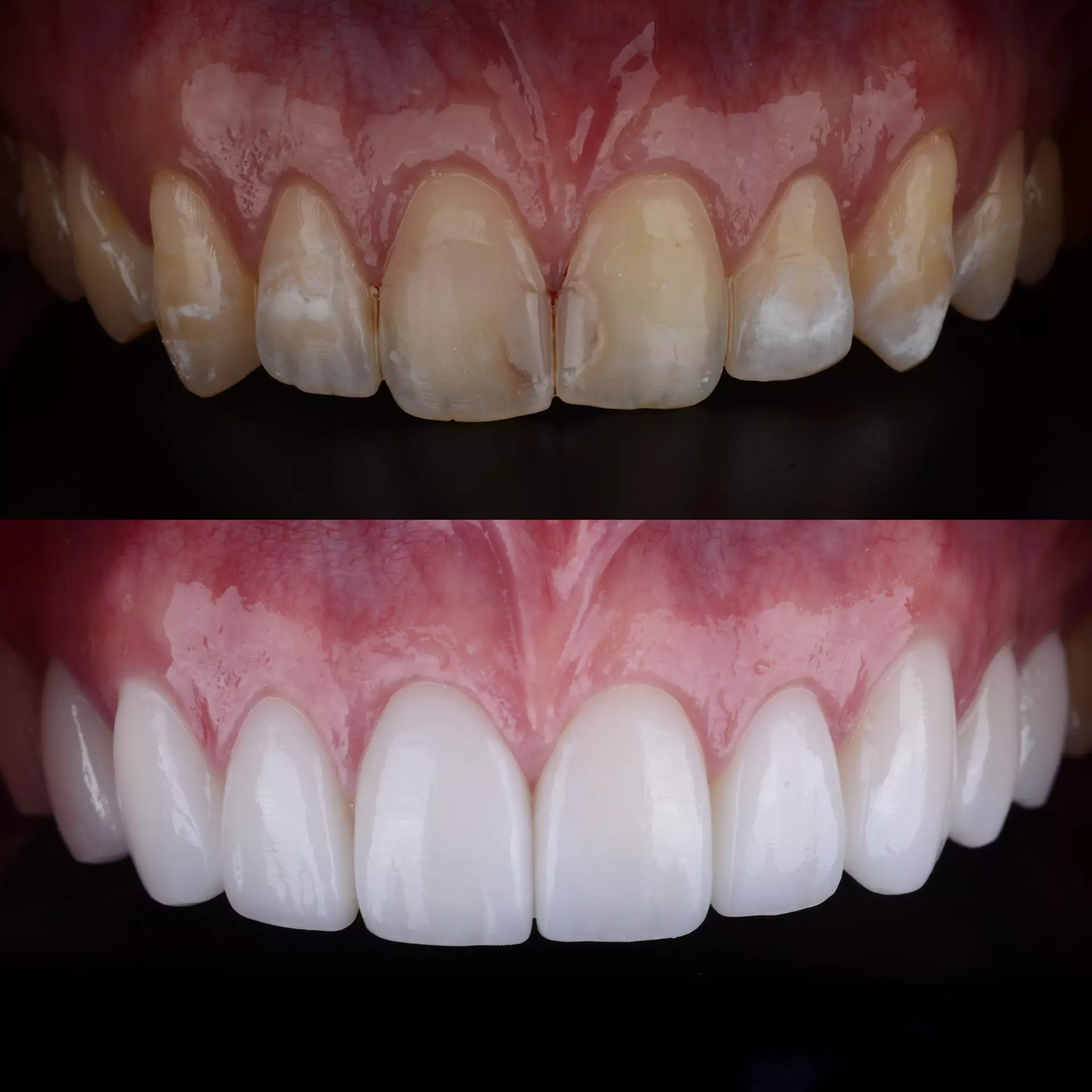 Veneers  Charleston, SC 