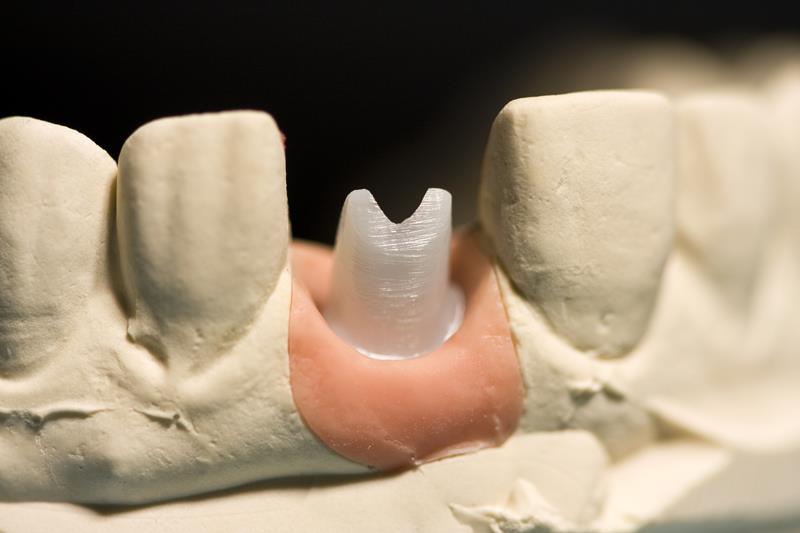 Implant Restoration  Charleston, SC 