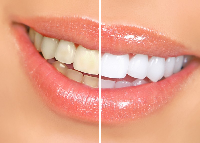 Teeth Whitening  Charleston, SC 