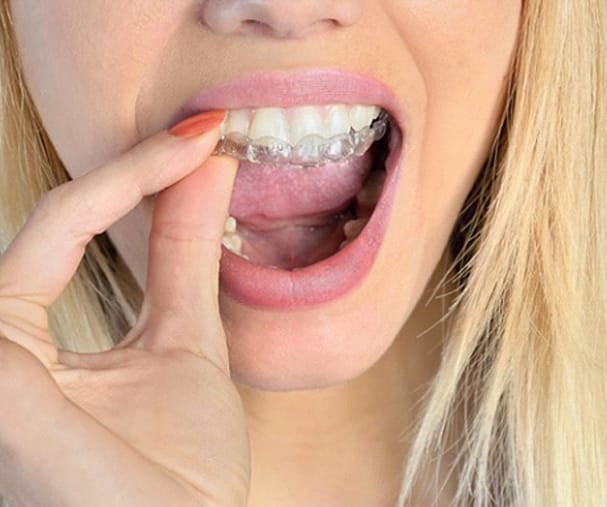 Invisalign  Charleston, SC 
