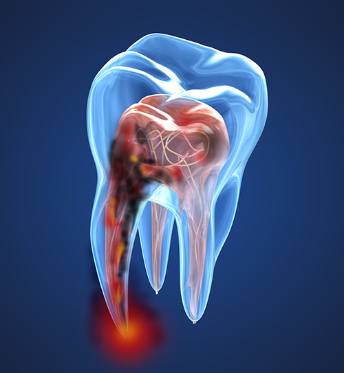 Root Canals  Charleston, SC 