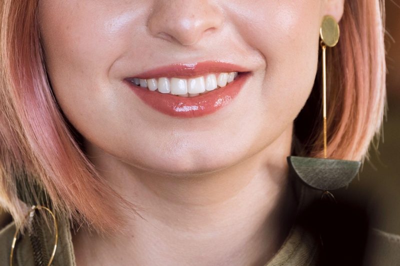 No-Prep & Ultra-Thin Veneers in James Island, SC