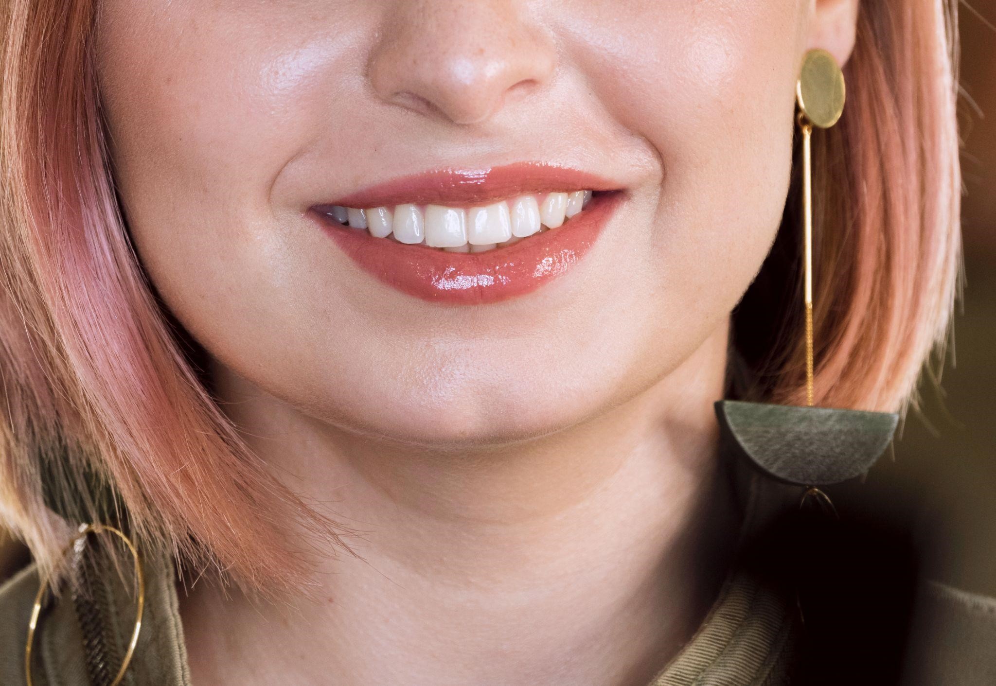 No-Prep & Ultra-Thin Veneers in James Island, SC